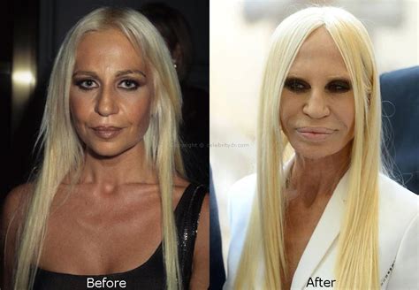 mickey rourke donatella versace|Extreme plastic surgery disasters and why they do it .